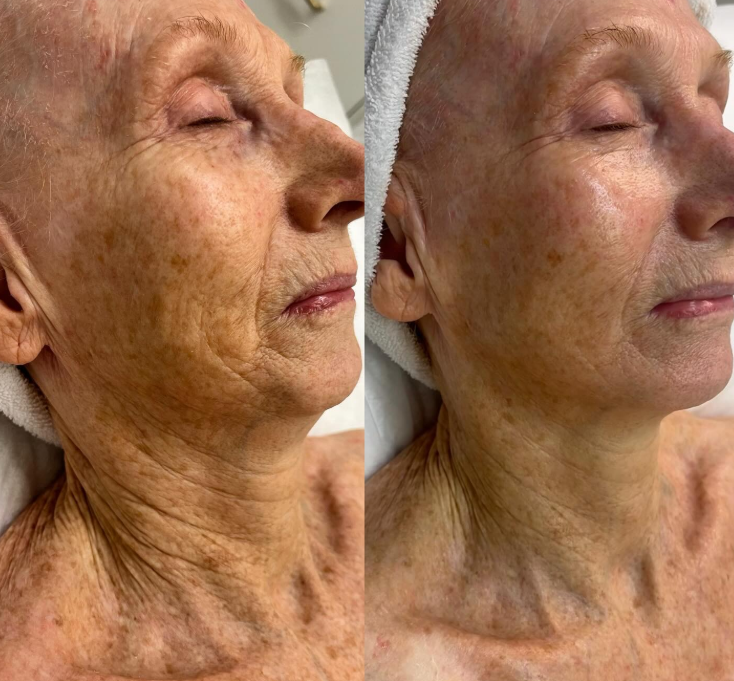 Skin rejuvenation using Raspberry Enzyme, Firming Peptide, and LED Therapy in just one treatment.